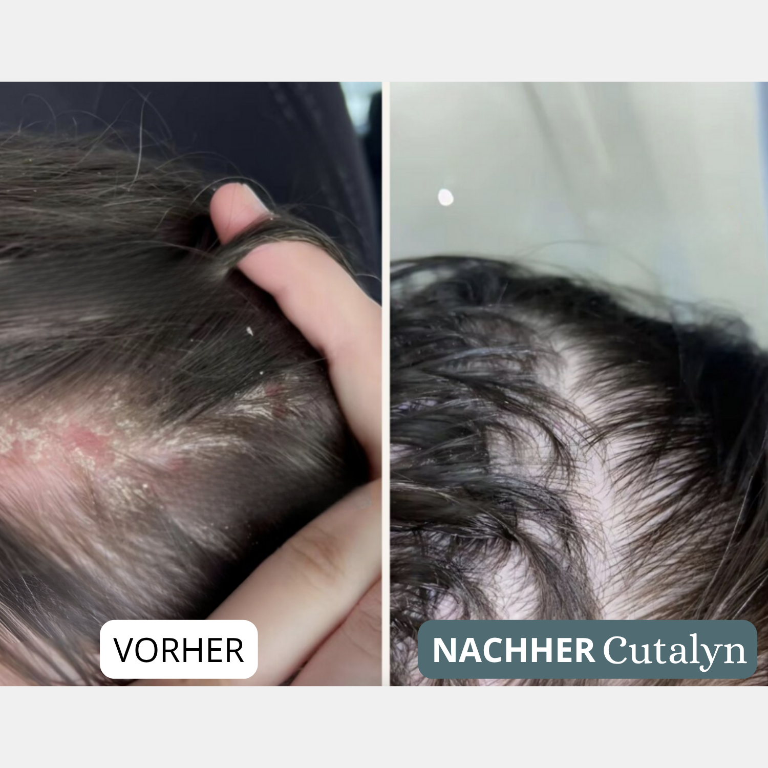 SensiCalm® Creme ⎜ Für eine saubere, gesunde und beruhigte Kopfhaut