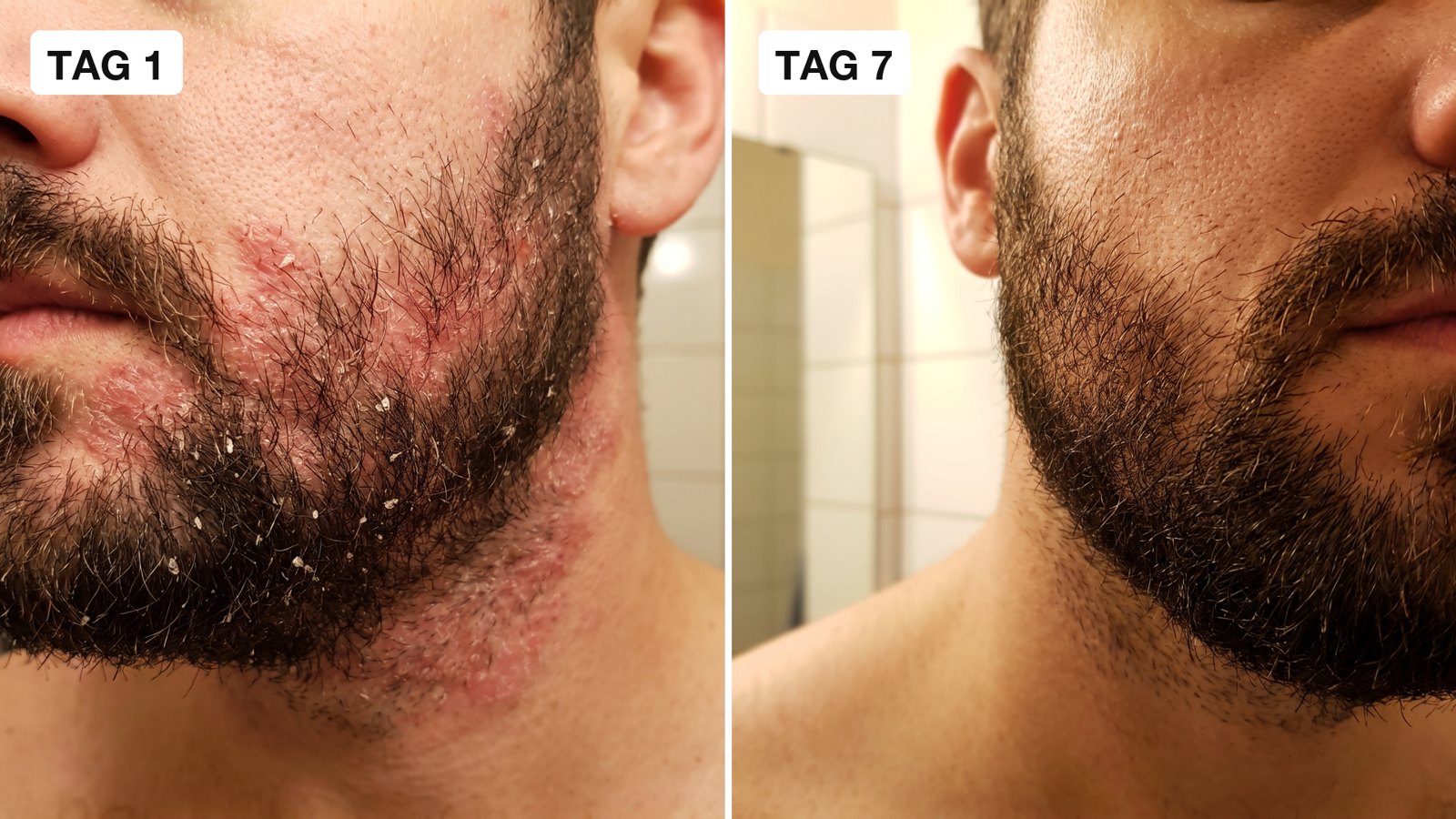 Vorher-Nachher: Bartschuppen und Rötung an Tag 1 und an Tag 7