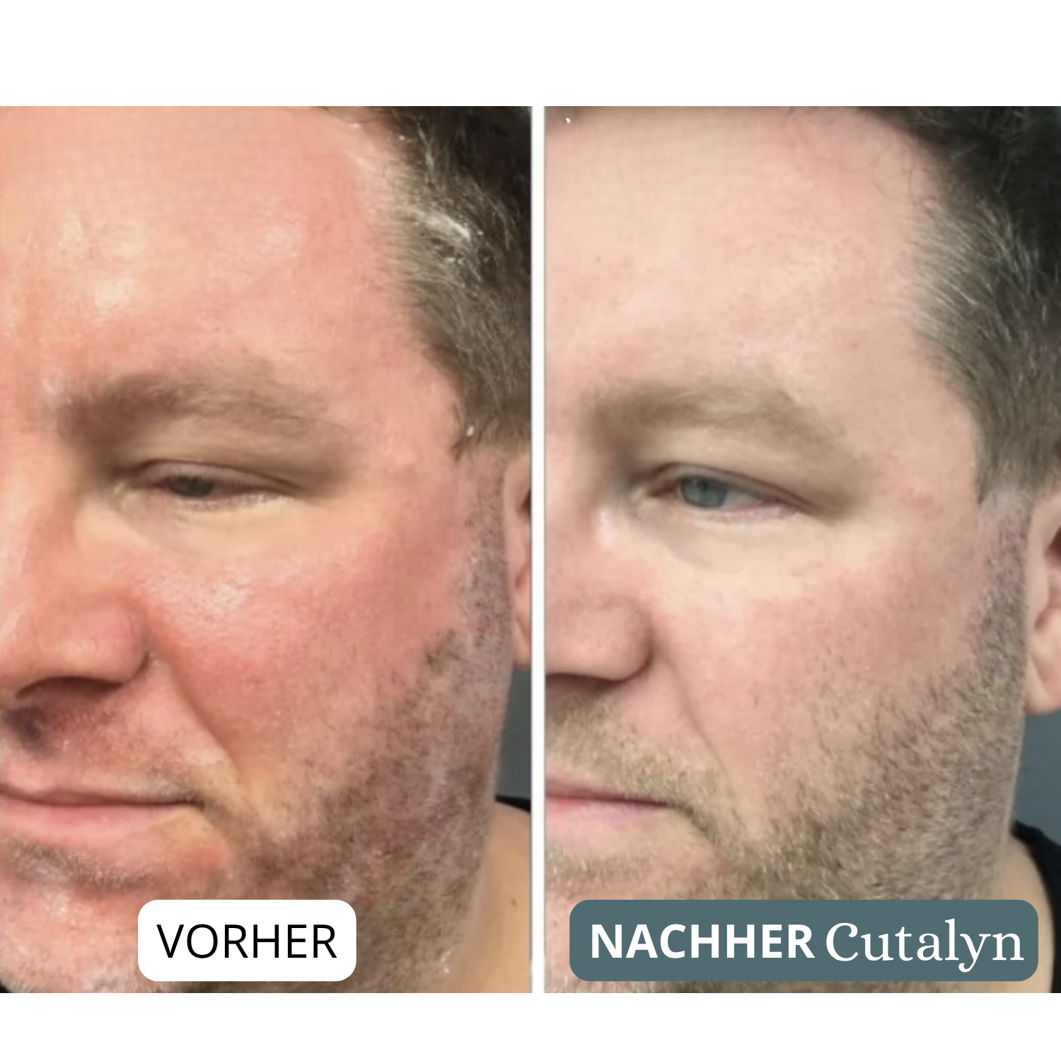 SensiCalm® Creme ⎜ Intensiv-Beruhigungspflege für Bart & Kopfhaut