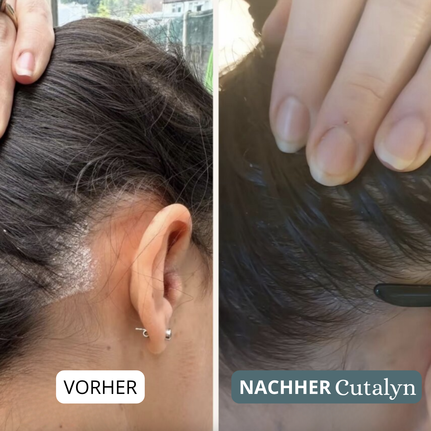 SensiCalm® Creme ⎜ Für eine saubere, gesunde und beruhigte Kopfhaut