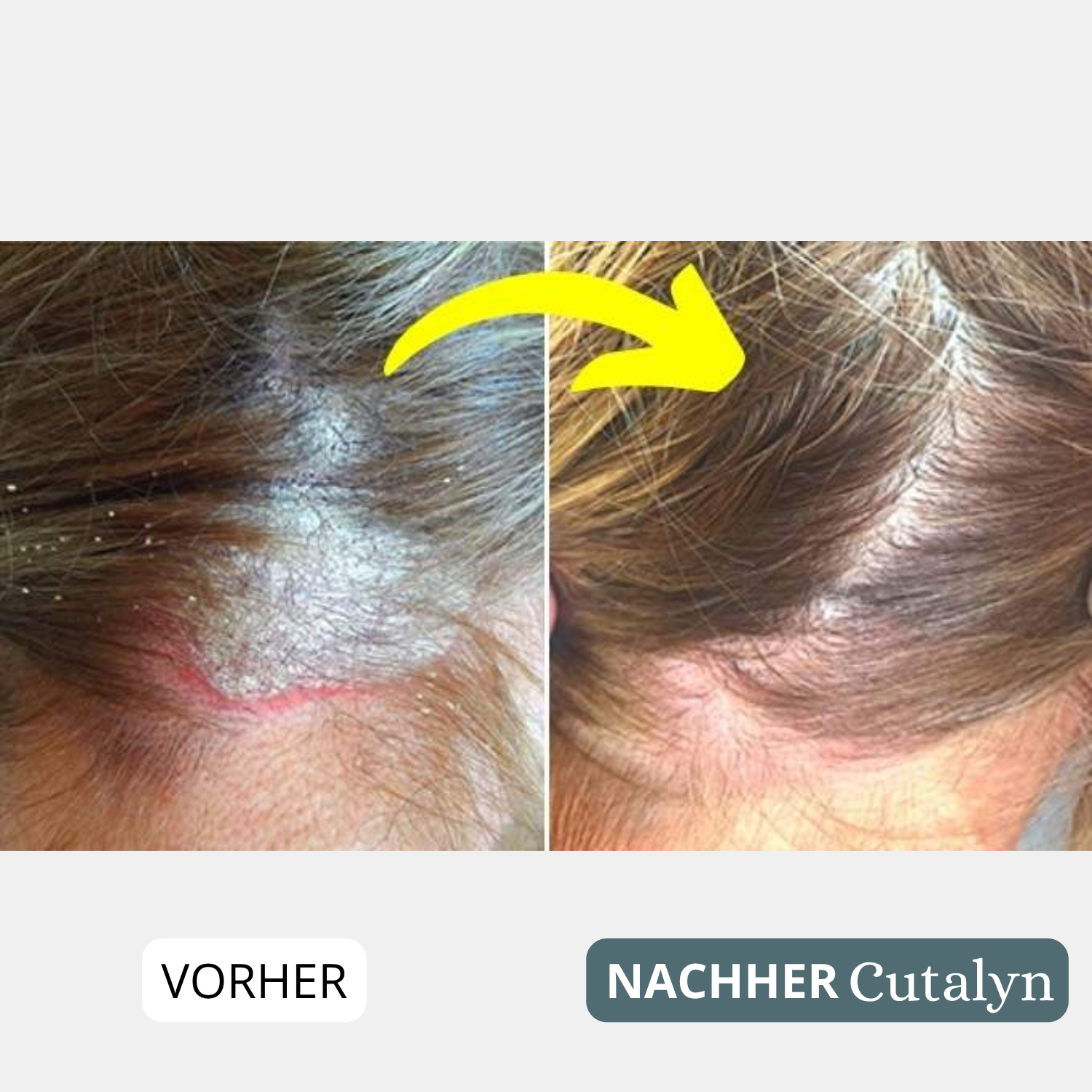 SensiCalm® Creme ⎜ Für eine saubere, gesunde und beruhigte Kopfhaut